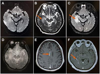 Influenza A H3N2-Associated Meningoencephalitis in an Older Adult With Viral RNA in Cerebrospinal Fluid: Case Report